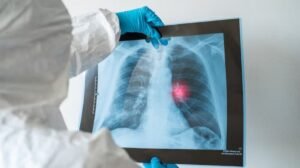 Kanker Paru-Paru: Memahami Ancaman, Perkembangan Terkini, dan Harapan di Masa Depan