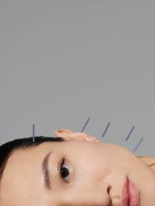 Akupunktur: Seni Penyembuhan Kuno yang Relevan di Era Modern