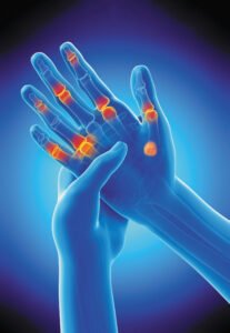 Arthritis: Memahami Lebih Dalam Tentang Nyeri Sendi yang Mengganggu Kualitas Hidup