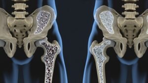 Osteoporosis: Tulang Rapuh, Ancaman Tersembunyi